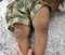 Scabies Infestation with secondary or superimposed bacterial infection and pustules in leg of Asian, Burmese child