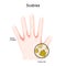 Scabies mite. Human`s hand. skin with Rashes