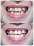 Before and after scaling and polishing treatment of tobacco stains on crowded teeth of Asian man