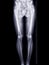 Scanogram of lower limb or X-ray image of total lower extremity with scale.