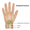 Scaphoid bone fracture medical  illustration on white background