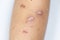 A scar is an area of fibrous tissue that replaces normal skin after an injury.