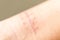 A scar is an area of fibrous tissue that replaces normal skin after an injury.