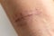 A scar is an area of fibrous tissue that replaces normal skin after an injury.