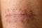 A scar is an area of fibrous tissue that replaces normal skin after an injury.