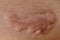 A scar is an area of fibrous tissue that replaces normal skin after an injury.