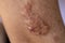 A scar is an area of fibrous tissue that replaces normal skin after an injury.