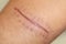 A scar of fibrous tissue that replaces normal skin after an injury on skin.