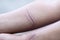 A scar of fibrous tissue that replaces normal skin after an injury on skin.