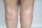 Scar on the knee of a senior woman,