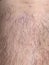 Scar on skin. The wound form scabs on leg. Man with long scab wound on right leg.