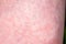 Scarlet Fever starts with a red rush and the strawberry tongue Afterwards the affected skin often peels - Here red skin