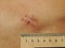 Scars on the abdomen of patient