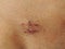 Scars on the abdomen of patient