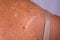 Scars on a lady\'s back from Skin Cancer