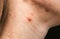 Scars and wounds on the neck after acne. Woman`s oily skin with problems acne