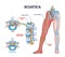 Sciatica as symptom from herniated disc and spinal nerve outline diagram