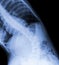 Scoliosis film x-ray show spinal bend