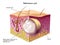 Sebaceous cyst