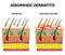 Seborrhea skin and hair. Dandruff seborrheic dermatitis. Eczema. Dysfunction of the sebaceous glands. Inflammatory skin disease.