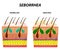 Seborrhea skin and hair. Dandruff seborrheic dermatitis. Eczema. Dysfunction of the sebaceous glands. Inflammatory skin disease.