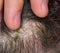Seborrhea symptom in scalp