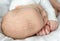 Seborrheic dermatitis crusts on the baby`s head. child with seborrhea in the hair