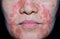 Seborrheic Dermatitis face