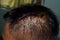 Seborrheic dermatitis at the scalp of Southeast Asian, Myanmar adult male patient