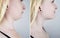 Second chin lift in women. Photos before and after plastic surgery, mentoplasty or facebuilding. Chin fat removal and face contour