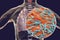 Secondary tuberculosis in lungs and close-up view of Mycobacterium tuberculosis bacteria