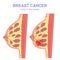 Sectional tumor and breast cancer