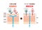 Sectional view of atopic dermatitis and normal skin / Comparative vector illustration Japanese