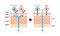 Sectional view of atopic dermatitis and normal skin / Comparative vector illustration Japanese