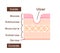 Sectional view illustration  of gastric ulcer