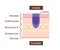 Sectional view illustration of stomach cancer gastric cancer