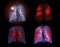 Selective focus of CT Chest or Lung 3D rendering image on the monitor  for diagnosis TB,tuberculosis and covid-19