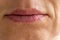 Senior woman`s corner of mouth with Herpes Labialis
