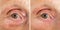 Senior Woman`s Eye With And Without Wrinkles