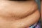 Senior women body fat belly front view, Black moles