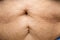 Senior women body fat belly front view, Sterilization scar, Black moles