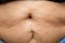 Senior women body fat belly front view, Sterilization scar, Black moles