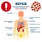 Sepsis vector illustration. Labeled infection condition educational scheme.