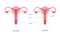 Septate and normal human uterus structure. Uterine septum as a congenital uterine malformation. Anatomy chart.