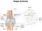 Septic Arthritis