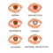 Set of the most common eye diseases isolated