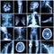 Set of X-ray multiple part of human,Multiple disease,orthopedic,surgery