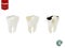 Set of realistic tooth including healthy tooth and decayed tooth