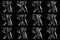 Set of sagittal MRI scans of neck area of caucasian male with bilateral paramedial extrusion of the C6-C7 segment with