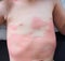 Severe eczema skin rash and allergic reaction symtom at child body cause by hypersensitivity